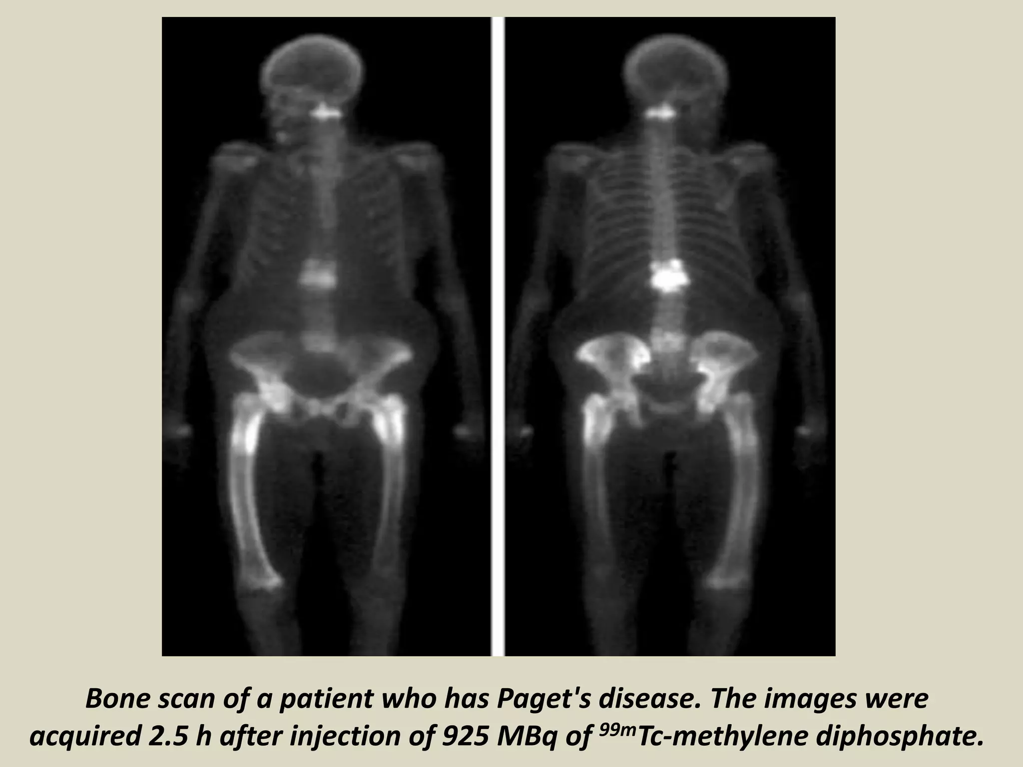 Bone scan of a patient who has Paget's disease. The images were
acquired 2.5 h after injection of 925 MBq of 99mTc-methylene diphosphate.
 
