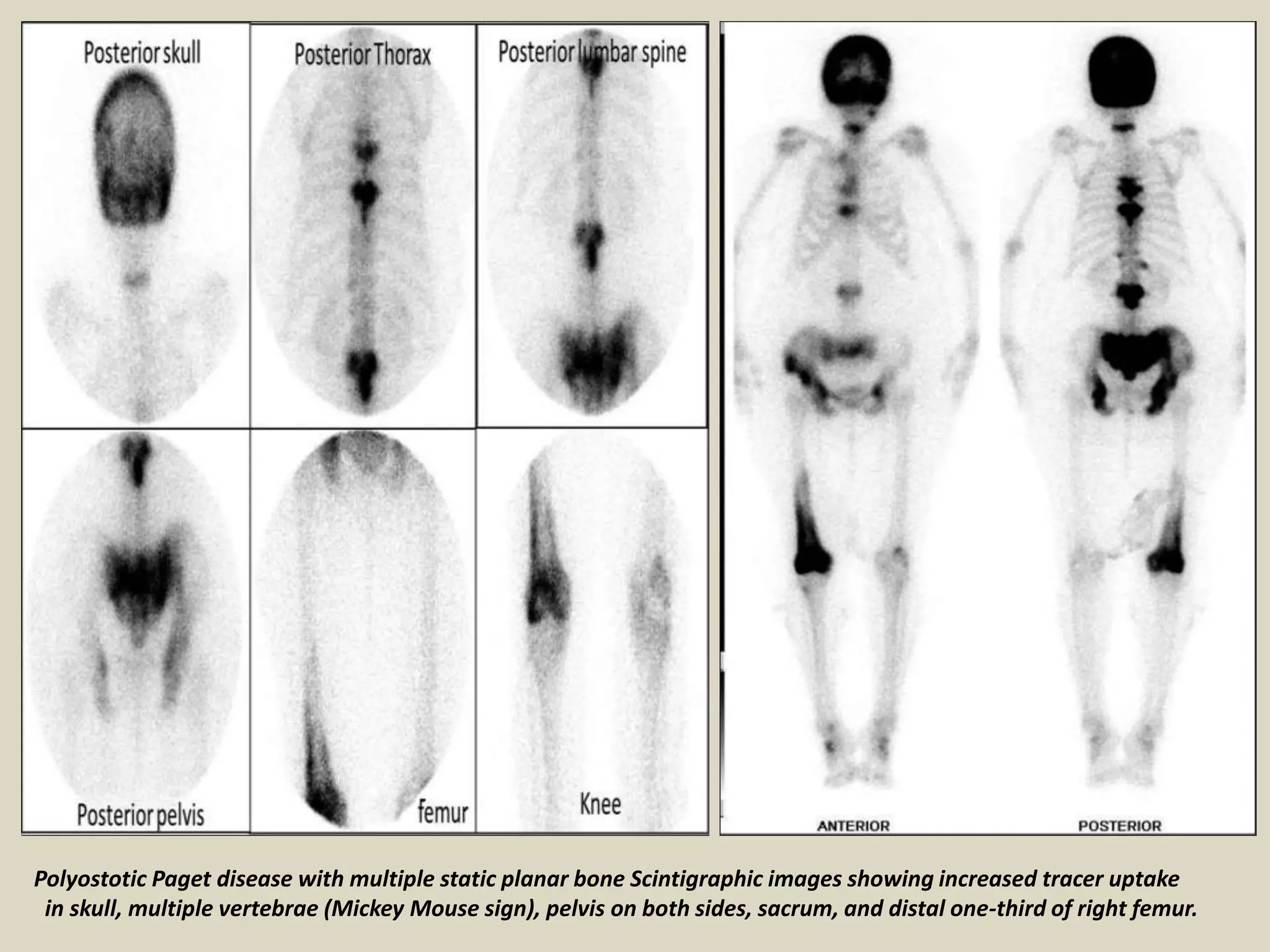 Polyostotic Paget disease with multiple static planar bone Scintigraphic images showing increased tracer uptake
in skull, multiple vertebrae (Mickey Mouse sign), pelvis on both sides, sacrum, and distal one-third of right femur.
 