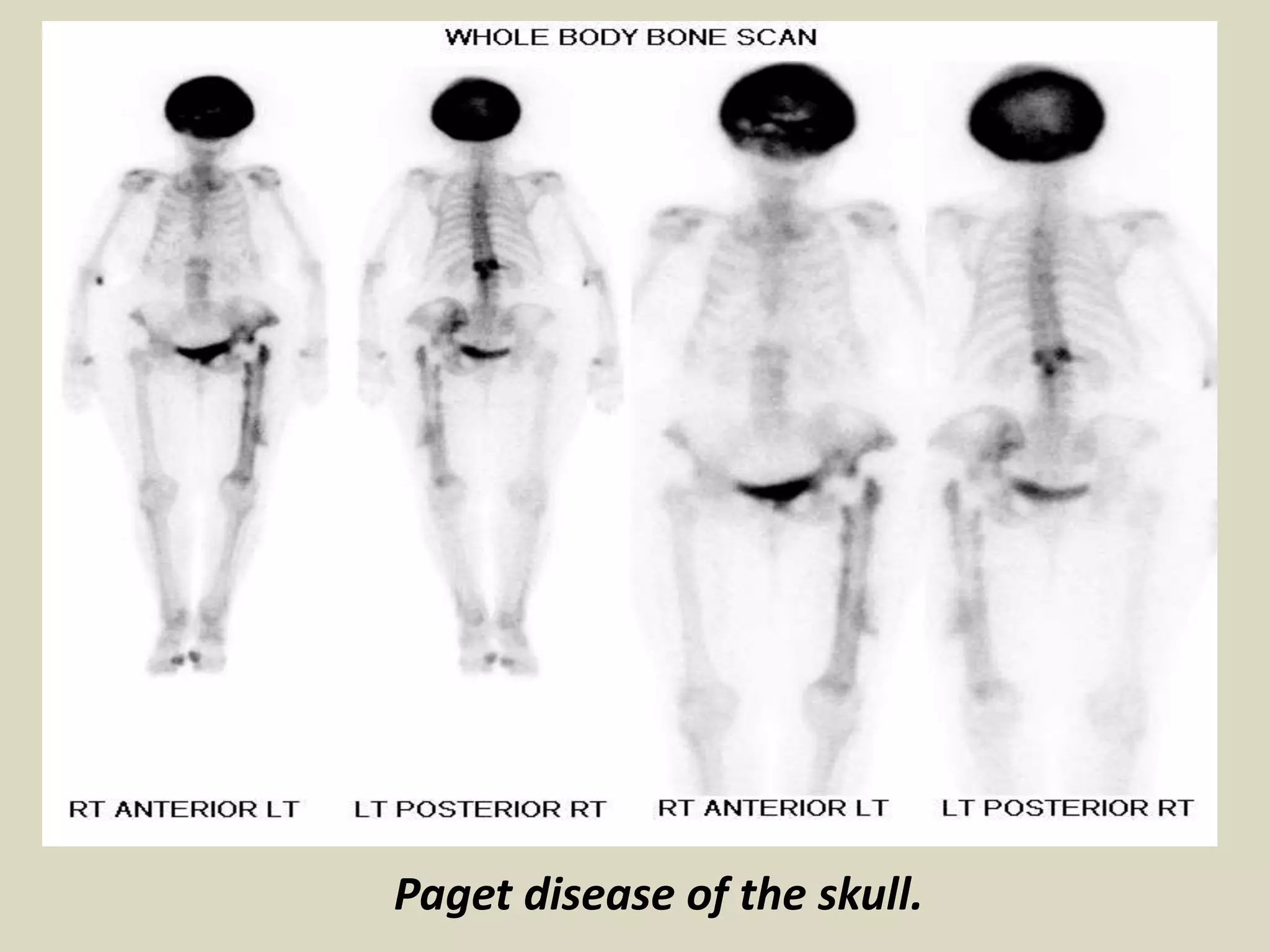 Paget disease of the skull.
 
