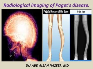 Dr/ ABD ALLAH NAZEER. MD.
Radiological imaging of Paget's disease.
 