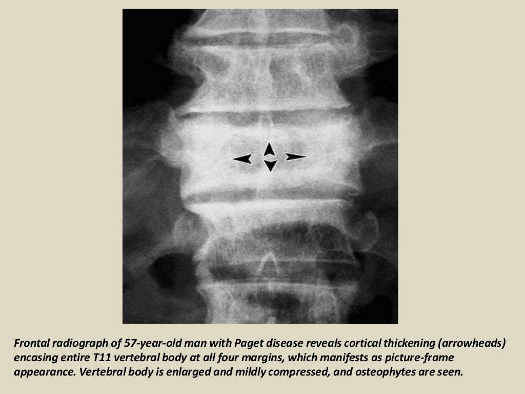 Presentation1.pptx, radiological imaging of paget disease.