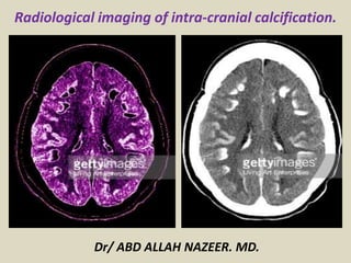Dr/ ABD ALLAH NAZEER. MD.
Radiological imaging of intra-cranial calcification.
 