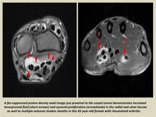 A fat-suppressed proton density axial image just proximal to the carpal tunnel demonstrates increased
tenosynovial fluid (short arrows) and synovial proliferation (arrowheads) in the radial and ulnar bursae
as well as multiple extensor tendon sheaths in this 45-year-old female with rheumatoid arthritis.
 