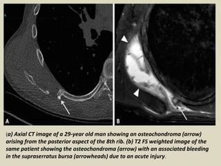 (a) Axial CT image of a 29-year old man showing an osteochondroma (arrow)
arising from the posterior aspect of the 8th rib. (b) T2 FS weighted image of the
same patient showing the osteochondroma (arrow) with an associated bleeding
in the supraserratus bursa (arrowheads) due to an acute injury.
 