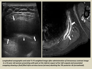 Longitudinal sonographic and axial T1 FS weighted image after administration of intravenous contrast image
in a 53-year old woman presenting with pain at the inferior aspect of her left scapula and associated
snapping showing a fluid filled infra-serratus bursa (arrows) abutting the 7th posterior rib (arrowhead).
 