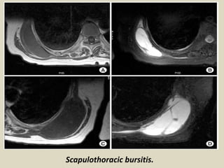 Scapulothoracic bursitis.
 