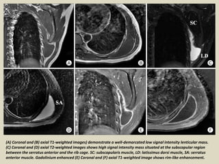 (A) Coronal and (B) axial T1-weighted images) demonstrate a well-demarcated low signal intensity lenticular mass.
(C) Coronal and (D) axial T2-weighted images shows high signal intensity mass situated at the subscapular region
between the serratus anterior and the rib cage. SC: subscapularis muscle, LD: latissimus dorsi muscle, SA: serratus
anterior muscle. Gadolinium enhanced (E) Coronal and (F) axial T1-weighted image shows rim-like enhancement.
 