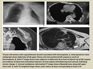 74-year-old woman with scapulothoracic bursitis associated with thoracoplasty. A, Anteroposterior chest
radiograph shows deformity of left upper thorax and mal-positioned left scapula as result of
thoracoplasty. B, Axial CT image shows mass adjacent to deformed rib at level of inferior tip of left scapula
and evidence of abnormal articulation between rib and scapula with flattening and sclerosis indicating
chronic change. C, Coronal multiplanar reformatted CT image shows ellipsoidal mass along left upper
chest wall. D, Axial T2-weighted image shows cystic nature of mass corresponding to lesion in B.
 