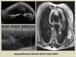 Scapulothoracic Bursitis of the Chest Wall.
 