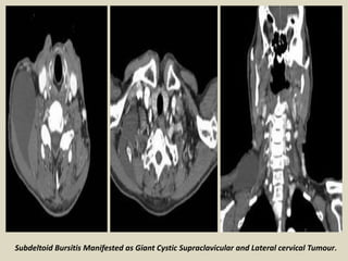 Subdeltoid Bursitis Manifested as Giant Cystic Supraclavicular and Lateral cervical Tumour.
 