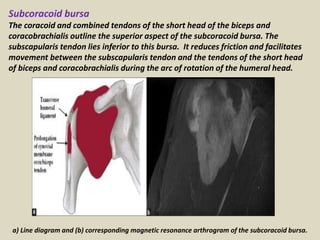 Subcoracoid bursa
The coracoid and combined tendons of the short head of the biceps and
coracobrachialis outline the superior aspect of the subcoracoid bursa. The
subscapularis tendon lies inferior to this bursa. It reduces friction and facilitates
movement between the subscapularis tendon and the tendons of the short head
of biceps and coracobrachialis during the arc of rotation of the humeral head.
a) Line diagram and (b) corresponding magnetic resonance arthrogram of the subcoracoid bursa.
 