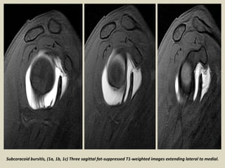 Subcoracoid bursitis, (1a, 1b, 1c) Three sagittal fat-suppressed T1-weighted images extending lateral to medial.
 