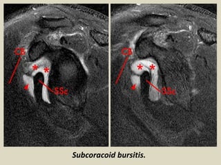 Subcoracoid bursitis.
 