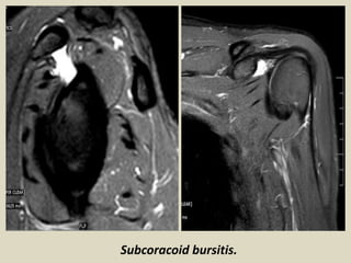 Subcoracoid bursitis.
 