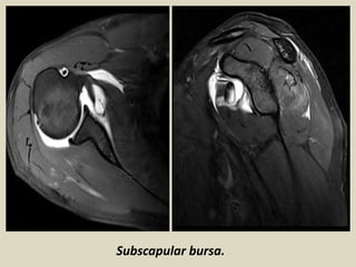 Subscapular bursa.
 