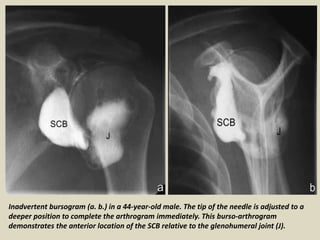 Inadvertent bursogram (a. b.) in a 44-year-old male. The tip of the needle is adjusted to a
deeper position to complete the arthrogram immediately. This burso-arthrogram
demonstrates the anterior location of the SCB relative to the glenohumeral joint (J).
 