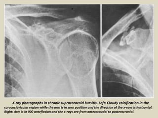 X-ray photographs in chronic supracoracoid bursitis. Left: Cloudy calcification in the
coracoclavicular region while the arm is in zero position and the direction of the x-rays is horizontal.
Right: Arm is in 900 anteflexion and the x-rays are from anterocaudal to posterocranial.
 