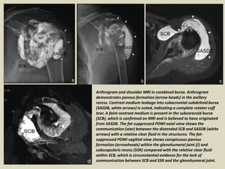 Arthrogram and shoulder MRI in combined bursa. Arthrogram
demonstrates pannus formation (arrow heads) in the axillary
recess. Contrast medium leakage into subacromial-subdeltoid bursa
(SASDB, white arrows) is noted, indicating a complete rotator cuff
tear. A faint contrast medium is present in the subcoracoid bursa
(SCB), which is confirmed on MRI and is believed to have originated
from SASDB. The fat-suppressed PDWI axial view shows the
communication (star) between the distended SCB and SASDB (white
arrows) with a relative clear fluid in the structures. The fat-
suppressed PDWI sagittal view shows conspicuous pannus
formation (arrowheads) within the glenohumeral joint (J) and
subscapularis recess (SSR) compared with the relative clear fluid
within SCB, which is circumstantial evidence for the lack of
communication between SCB and SSR and the glenohumeral joint.
 