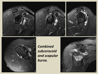 Combined
subcoracoid
and scapular
bursa.
 