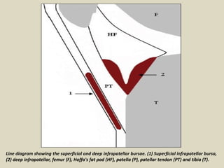 Line diagram showing the superficial and deep infrapatellar bursae. (1) Superficial infrapatellar bursa,
(2) deep infrapatellar, femur (F), Hoffa's fat pad (HF), patella (P), patellar tendon (PT) and tibia (T).
 