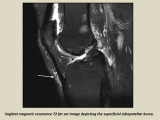 Sagittal magnetic resonance T2 fat sat image depicting the superficial infrapatellar bursa.
 