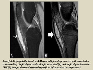 Superficial infrapatellar bursitis. A 42-year-old female presented with an anterior
knee swelling. Sagittal proton-density fat saturated (A) and sagittal gradient-echo
T2W (B) images show a distended superficial infrapatellar bursa (arrows)
 