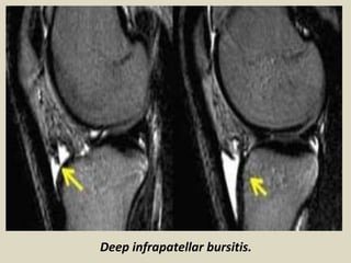 Deep infrapatellar bursitis.
 