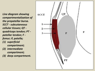 Line diagram showing
compartmentalization of
the prepatellar bursa.
SCCT - subcutaneous
cellular tissues; QT -
quadriceps tendon; PT -
patellar tendon; F -
femur; P, patella;
(1) superficial
compartment;
(2) intermediate
compartment;
(3) deep compartment.
 