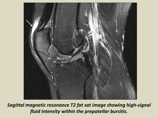 Sagittal magnetic resonance T2 fat sat image showing high-signal
fluid intensity within the prepatellar bursitis.
 