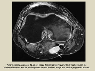 Axial magnetic resonance T2 fat sat image depicting Baker's cyst with its neck between the
semimembranosus and the medial gastrocnemius tendons. Image also depicts prepatellar bursitis.
 