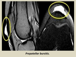Prepatellar bursitis.
 