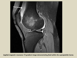 Sagittal magnetic resonance T2 gradient image demonstrating fluid within the suprapatellar bursa.
 