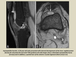 Suprapatellar bursitis. A 29-year-old male presented with internal derangement of the knee: sagittal proton
density fat saturated (A) and axial T2W gradient-echo (B) images show a distended suprapatellar bursa
(arrows) and in addition, a partial tear of the anterior cruciate ligament (thick arrow in A)
 