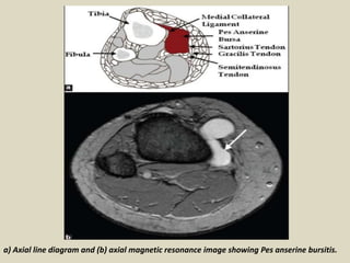a) Axial line diagram and (b) axial magnetic resonance image showing Pes anserine bursitis.
 