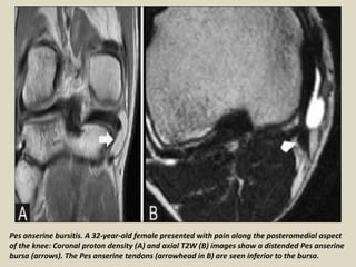 Pes anserine bursitis. A 32-year-old female presented with pain along the posteromedial aspect
of the knee: Coronal proton density (A) and axial T2W (B) images show a distended Pes anserine
bursa (arrows). The Pes anserine tendons (arrowhead in B) are seen inferior to the bursa.
 