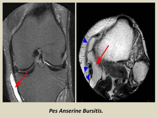 Pes Anserine Bursitis.
 