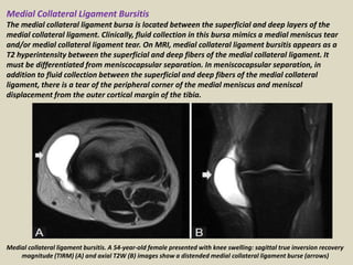 Medial Collateral Ligament Bursitis
The medial collateral ligament bursa is located between the superficial and deep layers of the
medial collateral ligament. Clinically, fluid collection in this bursa mimics a medial meniscus tear
and/or medial collateral ligament tear. On MRI, medial collateral ligament bursitis appears as a
T2 hyperintensity between the superficial and deep fibers of the medial collateral ligament. It
must be differentiated from meniscocapsular separation. In meniscocapsular separation, in
addition to fluid collection between the superficial and deep fibers of the medial collateral
ligament, there is a tear of the peripheral corner of the medial meniscus and meniscal
displacement from the outer cortical margin of the tibia.
Medial collateral ligament bursitis. A 54-year-old female presented with knee swelling: sagittal true inversion recovery
magnitude (TIRM) (A) and axial T2W (B) images show a distended medial collateral ligament burse (arrows)
 