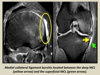 Medial collateral ligament bursitis located between the deep MCL
(yellow arrow) and the superficial MCL (green arrow).
 