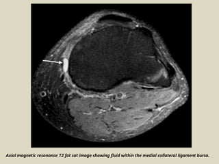 Axial magnetic resonance T2 fat sat image showing fluid within the medial collateral ligament bursa.
 