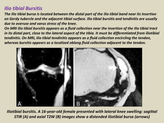 Ilio tibial Bursitis
The ilio tibial bursa is located between the distal part of the ilio tibial band near its insertion
on Gerdy tubercle and the adjacent tibial surface. Ilio tibial bursitis and tendinitis are usually
due to overuse and varus stress of the knee.
On MRI ilio tibial bursitis appears as a fluid collection near the insertion of the ilio tibial tract
in its distal part, close to the lateral aspect of the tibia. It must be differentiated from iliotibial
tendinitis. On MRI, ilio tibial tendinitis appears as a fluid collection encircling the tendon,
whereas bursitis appears as a localized oblong fluid collection adjacent to the tendon.
Iliotibial bursitis. A 16-year-old female presented with lateral knee swelling: sagittal
STIR (A) and axial T2W (B) images show a distended iliotibial bursa (arrows)
 
