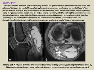 Baker's Cyst
This is also called a popliteal cyst and typically involves the gastrocnemius- semimembranosus bursa and
is located between the medial femoral condyle, semimembranosus tendon and the medial head of the
gastrocnemius. It may or may not communicate with the knee joint. It may rupture and extend inferiorly
along the gastrocnemius muscle into the calf or extend superiorly into thigh along the semimembranosus.
On MRI they appear as well-defined hyperintense lesions on T2W images at the characteristic location.
Axial images are the best to demonstrate the communication with the knee joint and also the
characteristic location between the semimembranosus tendon and medial head of gastrocnemius.
Baker's cyst. A 48-year-old male presented with swelling in the popliteal fossa: sagittal (A) and axial (B)
T2W gradient-echo images show a distended gastrocnemius--semimembranosus bursa (arrows)
 