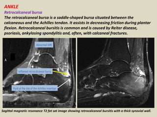 ANKLE
Retrocalcaneal bursa
The retrocalcaneal bursa is a saddle-shaped bursa situated between the
calcaneous and the Achilles tendon. It assists in decreasing friction during plantar
flexion. Retrocalcaneal bursitis is common and is caused by Reiter disease,
psoriasis, ankylosing spondylitis and, often, with calcaneal fractures.
Sagittal magnetic resonance T2 fat sat image showing retrocalcaneal bursitis with a thick synovial wall.
 