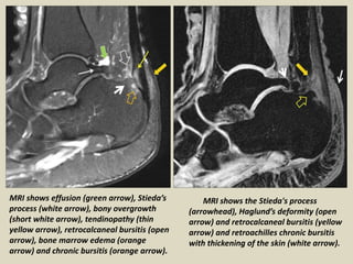 MRI shows effusion (green arrow), Stieda’s
process (white arrow), bony overgrowth
(short white arrow), tendinopathy (thin
yellow arrow), retrocalcaneal bursitis (open
arrow), bone marrow edema (orange
arrow) and chronic bursitis (orange arrow).
MRI shows the Stieda's process
(arrowhead), Haglund’s deformity (open
arrow) and retrocalcaneal bursitis (yellow
arrow) and retroachilles chronic bursitis
with thickening of the skin (white arrow).
 