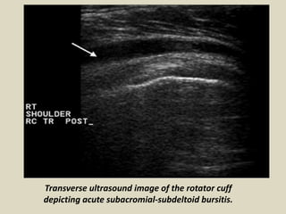 Transverse ultrasound image of the rotator cuff
depicting acute subacromial-subdeltoid bursitis.
 