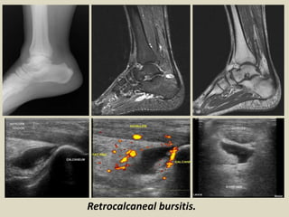 Retrocalcaneal bursitis.
 