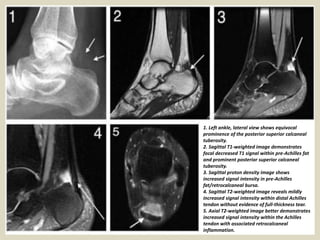 1. Left ankle, lateral view shows equivocal
prominence of the posterior superior calcaneal
tuberosity.
2. Sagittal T1-weighted image demonstrates
focal decreased T1 signal within pre-Achilles fat
and prominent posterior superior calcaneal
tuberosity.
3. Sagittal proton density image shows
increased signal intensity in pre-Achilles
fat/retrocalcaneal bursa.
4. Sagittal T2-weighted image reveals mildly
increased signal intensity within distal Achilles
tendon without evidence of full-thickness tear.
5. Axial T2-weighted image better demonstrates
increased signal intensity within the Achilles
tendon with associated retrocalcaneal
inflammation.
 
