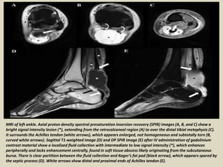 MRI of left ankle. Axial proton density spectral presaturation inversion recovery (SPIR) images (A, B, and C) show a
bright signal intensity lesion (*), extending from the retrocalcaneal region (A) to over the distal tibial metaphysis (C).
It surrounds the Achilles tendon (white arrows), which appears enlarged, not homogeneous and subtotally torn (B,
curved white arrows). Sagittal T1-weighted image (D) and DP SPIR image (E) after IV administration of gadolinium
contrast material show a localized fluid collection with intermediate to low signal intensity (*), which enhances
peripherally and lacks enhancement centrally, found in soft tissue abscess likely originating from the subcutaneous
bursa. There is clear partition between the fluid collection and Kager’s fat pad (black arrow), which appears spared by
the septic process (D). White arrows show distal and proximal ends of Achilles tendon (E).
 