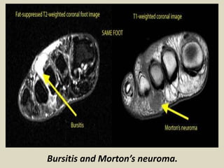 Bursitis and Morton’s neuroma.
 