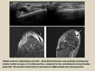 Tibialis anterior subtendinous bursitis - Note fluid distension only partially involving the
tendon (white arrows), in its distal portion, compared to the contralateral normal tendon
(asterisk). This partial involvement is necessary to differentiate from tenosynovitis.
 