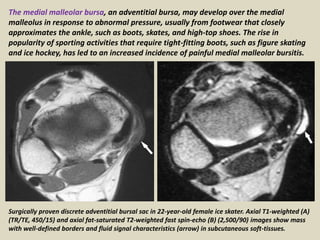 Surgically proven discrete adventitial bursal sac in 22-year-old female ice skater. Axial T1-weighted (A)
(TR/TE, 450/15) and axial fat-saturated T2-weighted fast spin-echo (B) (2,500/90) images show mass
with well-defined borders and fluid signal characteristics (arrow) in subcutaneous soft-tissues.
The medial malleolar bursa, an adventitial bursa, may develop over the medial
malleolus in response to abnormal pressure, usually from footwear that closely
approximates the ankle, such as boots, skates, and high-top shoes. The rise in
popularity of sporting activities that require tight-fitting boots, such as figure skating
and ice hockey, has led to an increased incidence of painful medial malleolar bursitis.
 